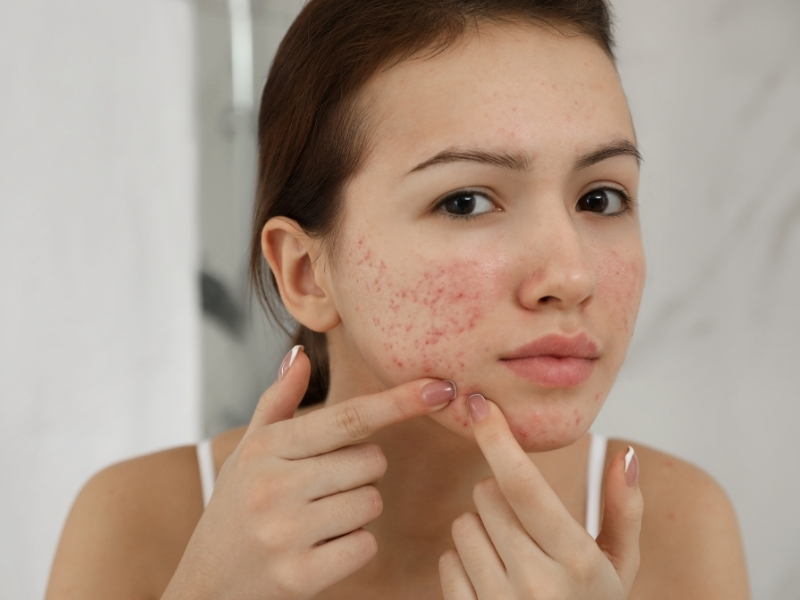 breakouts caused by damaged skin barrier