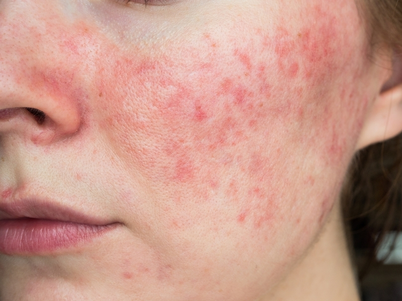 close-up of irritated skin from blue light exposure