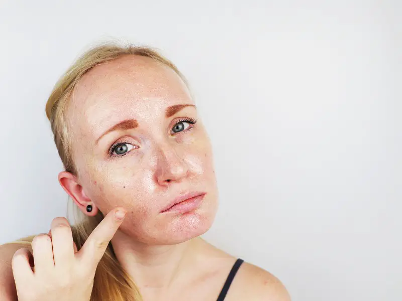 Woman with oily skin applying lightweight retinol gel