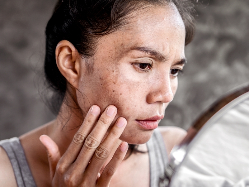 woman with hyperpigmentation spots